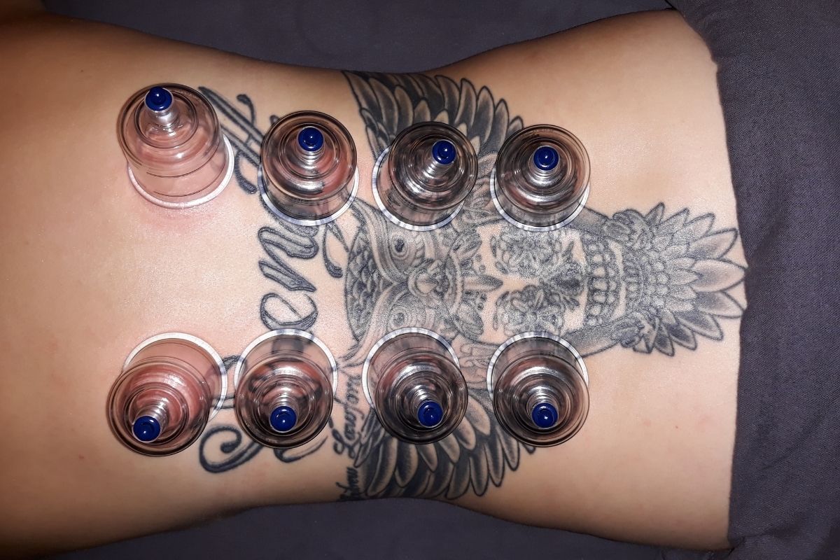 Cupping the spinal muscles Tattooed woman lying face down during a cupping therapy session, with visible cups placed on her back to relieve muscle tension and promote healing.
